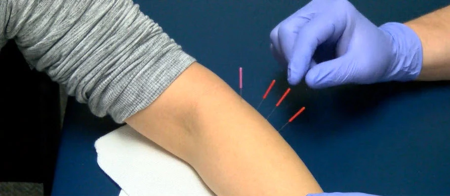 Dry Needling at Physical Therapy