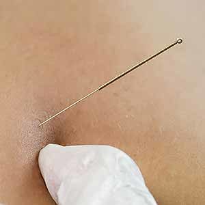 Dry Needling at Fitzgerald Physical Therapy